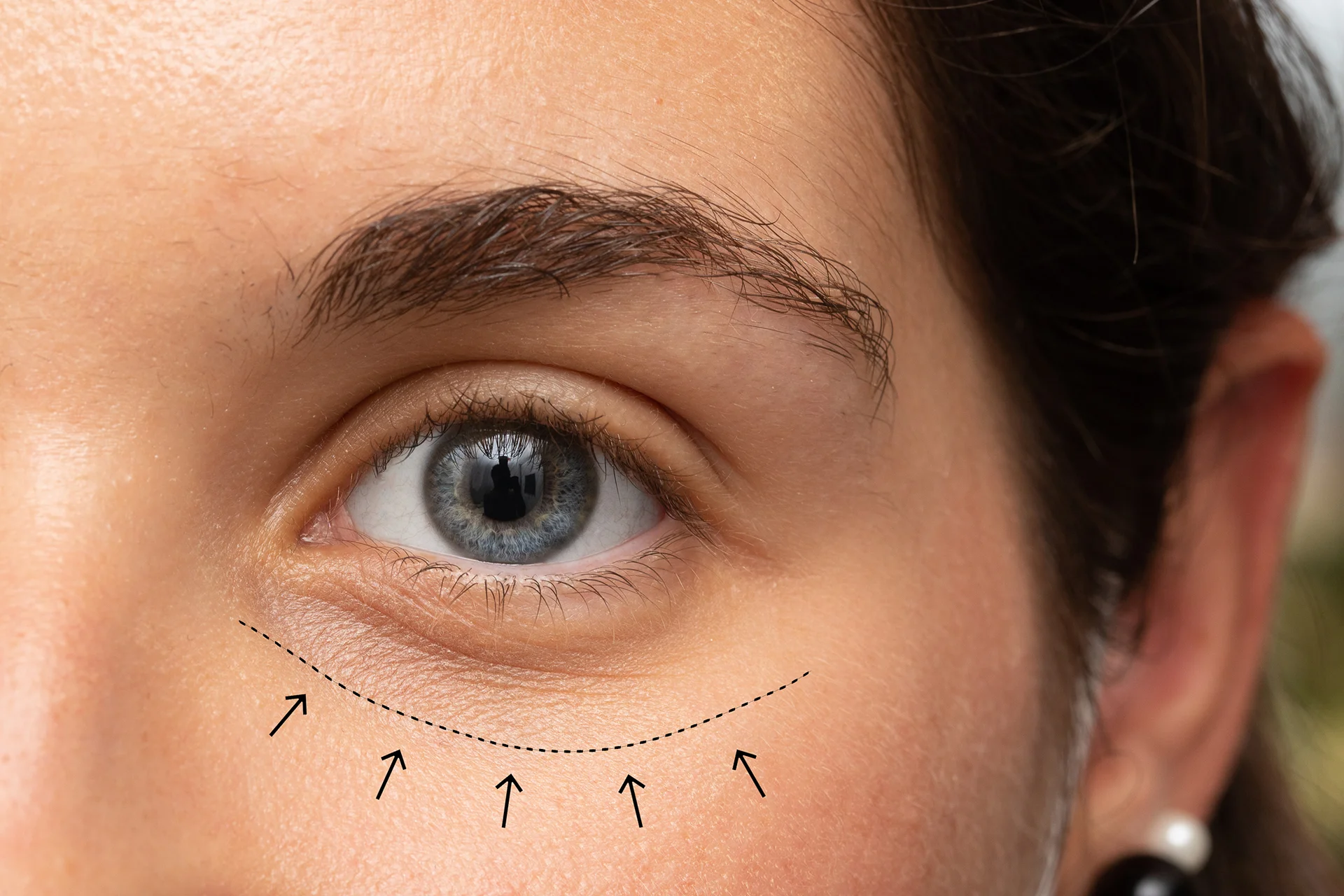Cheek and Undereye Filler